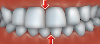 A crossbite occurs when one or more of your upper teeth don’t line up with the appropriate lower tooth or teeth .