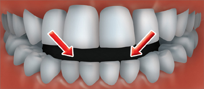 An open bite occurs when the back teeth are together and there is an opening between the lower and upper front teeth.