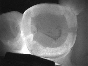 Image 35 Decay (cavity) present on the distal (back) portion of the tooth - the dark area that shows up